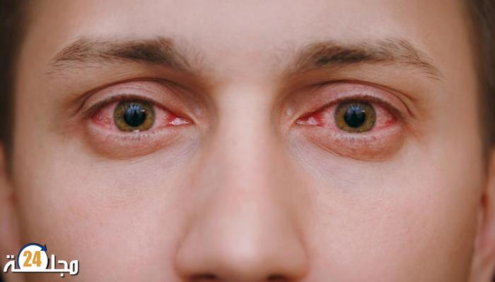كوفيد 19: كيف يؤثر الفيروس على صحة العين؟