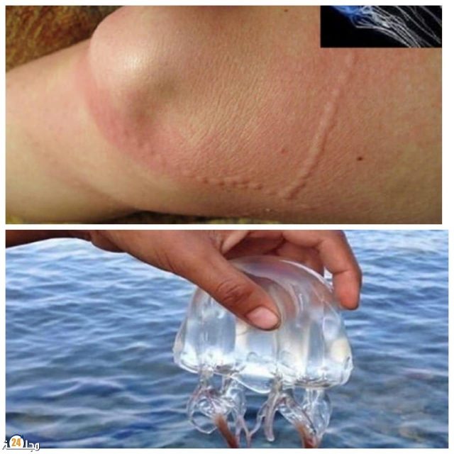 قناديل البحر تهاجم عددا من الأشخاص بشاطئ مدينة الجديدة