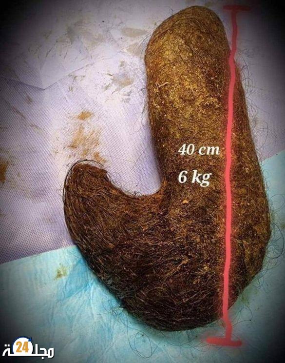 استخراج 6 كيلوغرامات من الشعر من بطن عشرينية