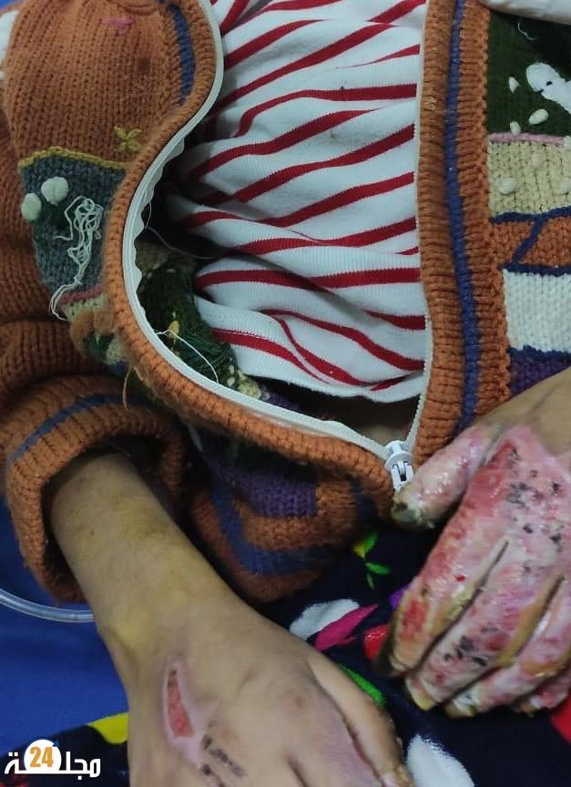 شكوك تحوم حول تعذيب جدة لحفيدتها حرقا و أمن سطات يدخل على الخط