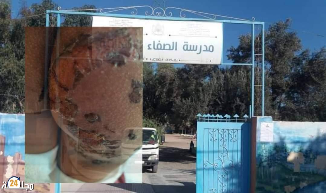 الشرطة بيوكرى تستمع لأم بعد اكتشاف حروق بليغة في مؤخرة إبنتها