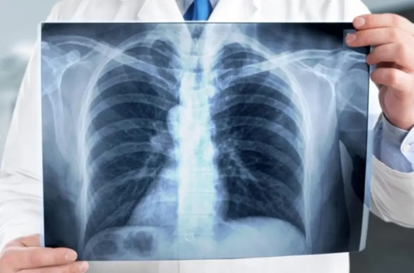 وزارة الصحة تطلق الحملة الوطنية للكشف عن داء السل