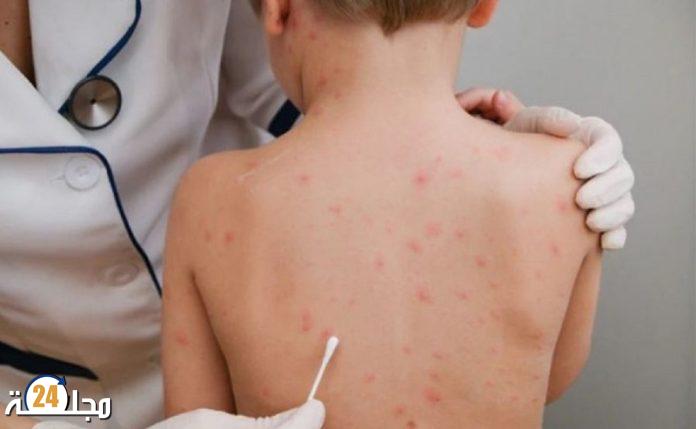 « جدري القردة ».. المغرب يشدد المراقبة الصحية في نقط العبور تأهبا لأي طارئ