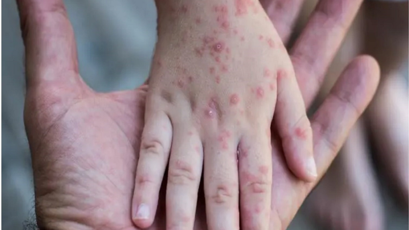 منظمة الصحة العالمية: جدري القردة يشكل “تهديدا متطورا” يحتاج إلى استجابة جماعية