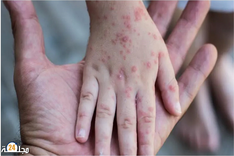 منظمة الصحة العالمية: جدري القردة يشكل “تهديدا متطورا” يحتاج إلى استجابة جماعية