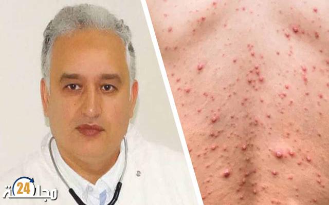 الطيب حمضي: لا يمكن إعطاء لقاح الجدري إلا للمخالطين