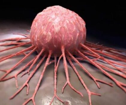 طبيب يدحض أوهاما شائعة عن السرطان