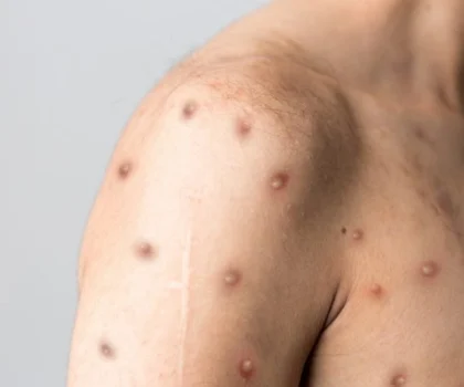 الموافقة على استخدام لقاح مضاد للجدري للوقاية من جدري القردة