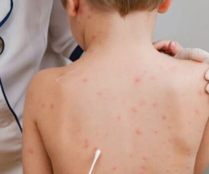 مخاوف جديدة من جدري القردة