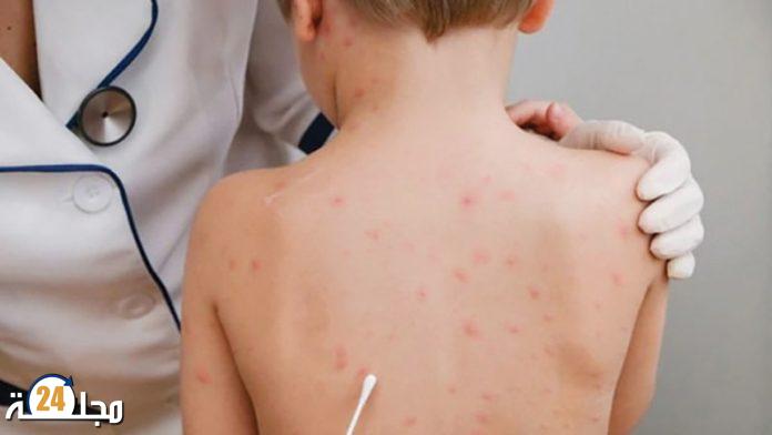 مخاوف جديدة من جدري القردة