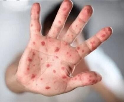 إسبانيا تعلن عن تسجيل 2835 إصابة مؤكدة بجدري القرود