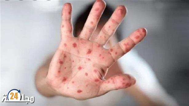 إسبانيا تعلن عن تسجيل 2835 إصابة مؤكدة بجدري القرود