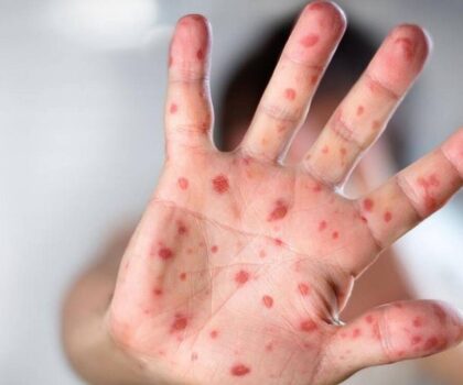 الولايات المتحدة تعلن مرض جدري القردة “حالة طوارئ صحية”