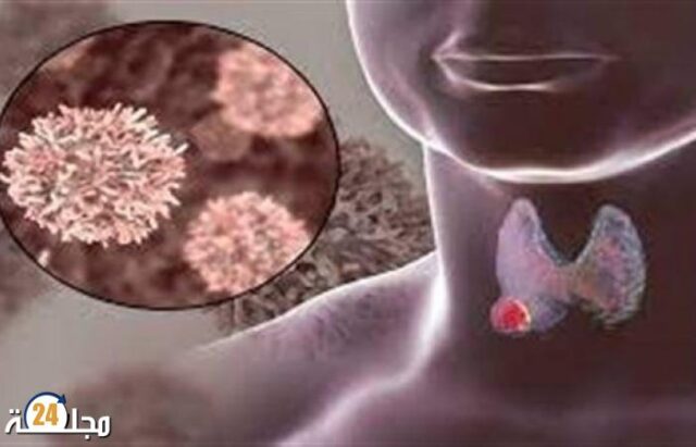 هذه هي العلامات المميزة لسرطان الغدة الدرقية