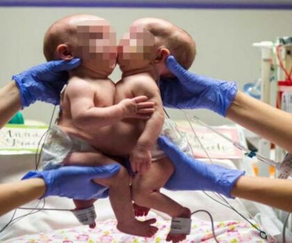 نجاح عملية فصل دماغي توأمين ملتصقين بلندن