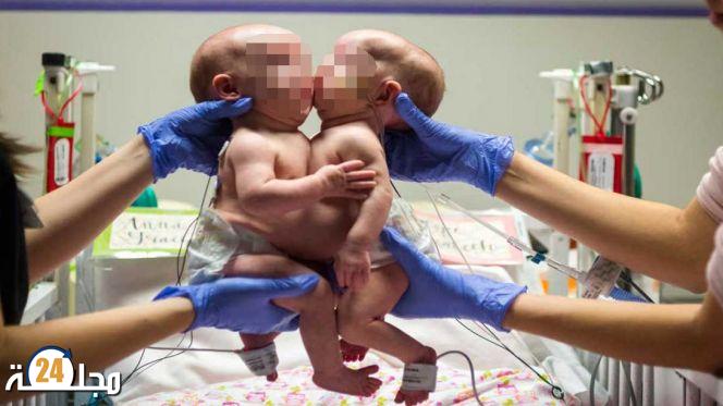 نجاح عملية فصل دماغي توأمين ملتصقين بلندن