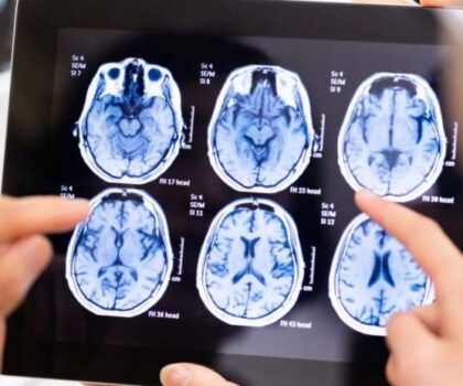أطباء يبتكرون طريقة جديدة لتدمير خلايا الورم في الدماغ