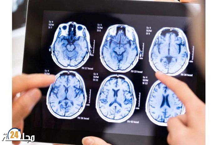 أطباء يبتكرون طريقة جديدة لتدمير خلايا الورم في الدماغ