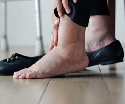 تورم الساقين قد يشير إلى مرحلة متقدمة من السرطان