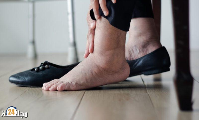 تورم الساقين قد يشير إلى مرحلة متقدمة من السرطان