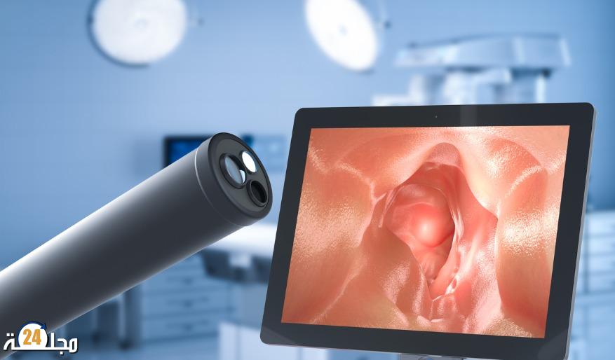 اكتشاف طريقة لتشخيص سرطان القولون والمستقيم في مرحلة مبكرة