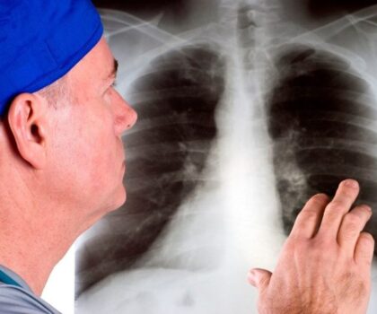 علامات السعال التي قد تدل على ورم سرطان الرئة!