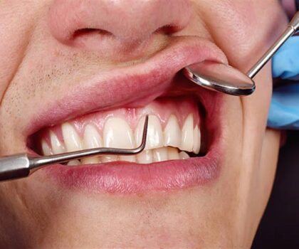 صحة الفم السيئة يمكن أن تؤدي إلى خراجات دماغية قاتلة