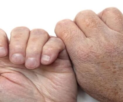 “علاج جديد” يبشر بنهاية معاناة مصابين بمرض جلدي نادر