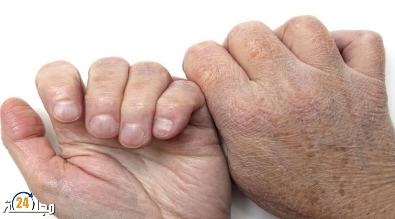 “علاج جديد” يبشر بنهاية معاناة مصابين بمرض جلدي نادر