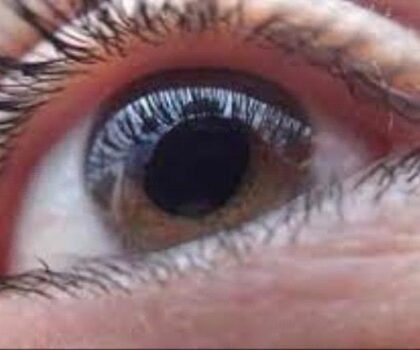 زرع عدسة خلف القرنية ينقذك من مرض الزهايمر