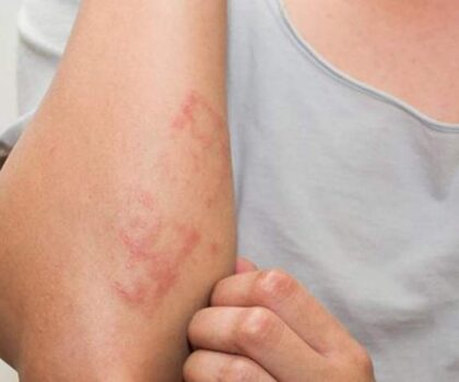 السكن قرب الطرقات الرئيسية يزيد فرص الإصابة بـ”مرض جلدي”