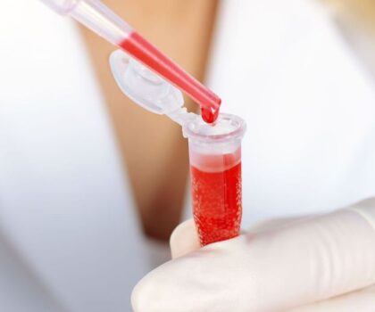 هل يمكن لفصيلة دمك أن تتنبأ بخطر السكتة الدماغية؟