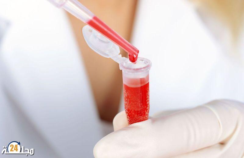 هل يمكن لفصيلة دمك أن تتنبأ بخطر السكتة الدماغية؟