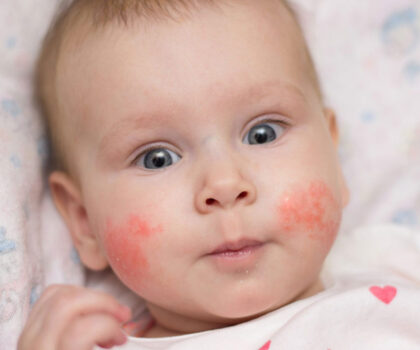 الأسباب المتغيرة لحساسية الجلد عند الأطفال