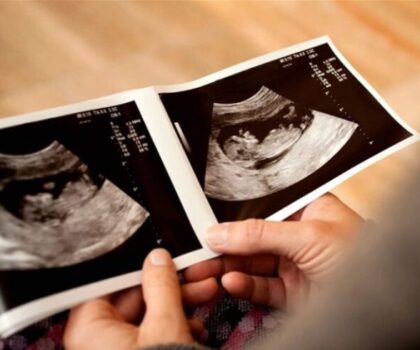 استقر في بطنها 9 سنوات.. جنين متحجر ينهي حياة والدته