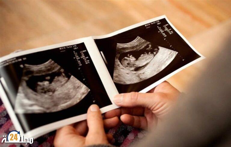 استقر في بطنها 9 سنوات.. جنين متحجر ينهي حياة والدته