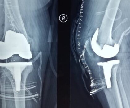 مستوحى من أجنحة الحشرات.. علماء يطورون طلاء لزراعة العظام