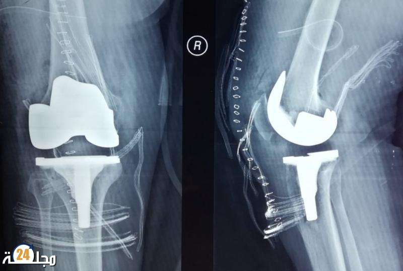 مستوحى من أجنحة الحشرات.. علماء يطورون طلاء لزراعة العظام