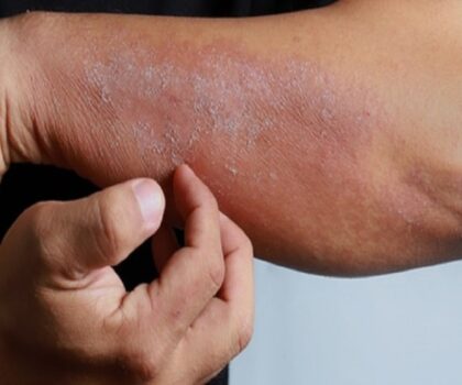 معد للغاية.. تسجيل أول إصابتين بمرض جلدي “خطير” في هذا البلد