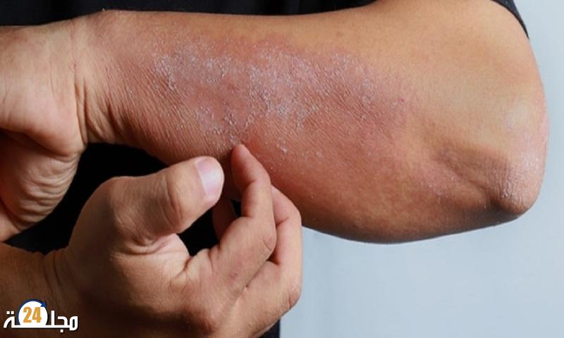 معد للغاية.. تسجيل أول إصابتين بمرض جلدي “خطير” في هذا البلد