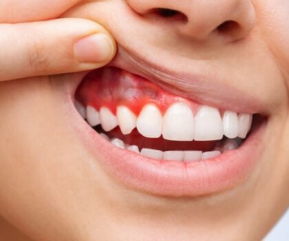 كشف خطورة التهاب اللثة على الدماغ