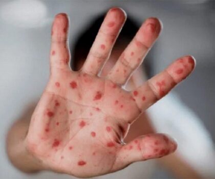 دولة أسوية تُسجل 11 حالة إصابة بجدري القردة