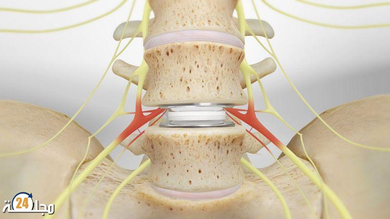 دواء جديد يعطي الأمل لمرضى الانزلاق الغضروفي