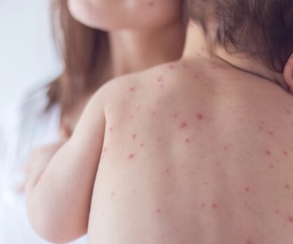 لمكافحة “بوحمرون”: مدارس تطالب التلاميذ بإحضار دفاترهم الصحية للتحقق من التلقيحات