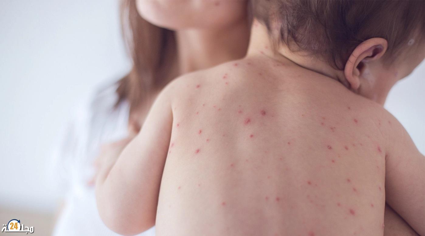 لمكافحة “بوحمرون”: مدارس تطالب التلاميذ بإحضار دفاترهم الصحية للتحقق من التلقيحات