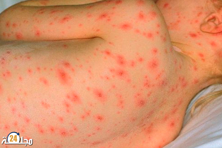 انتشار داء الحصبة بوحمرون في المغرب: تحول إلى وباء وتسجيل 120 وفاة