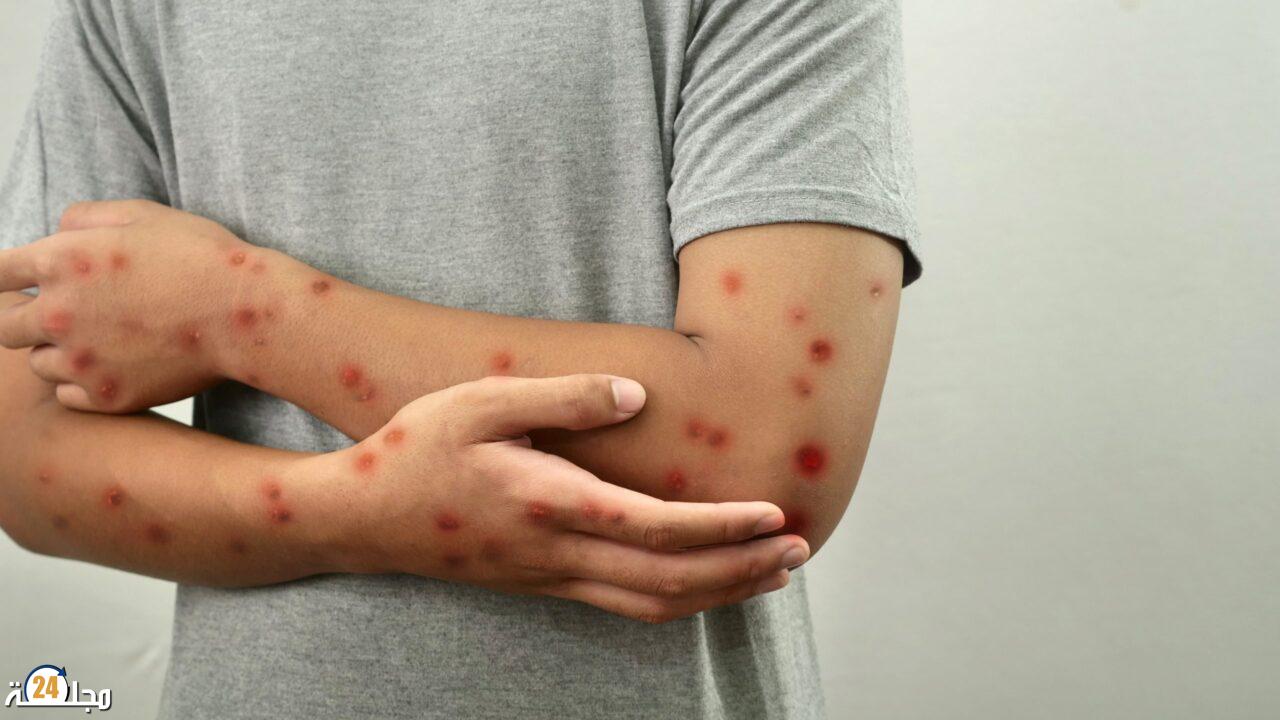 بوحمرون.. نقص التلقيح أو عدم استكمال الجرعات وراء انتشار الوباء بالمغرب
