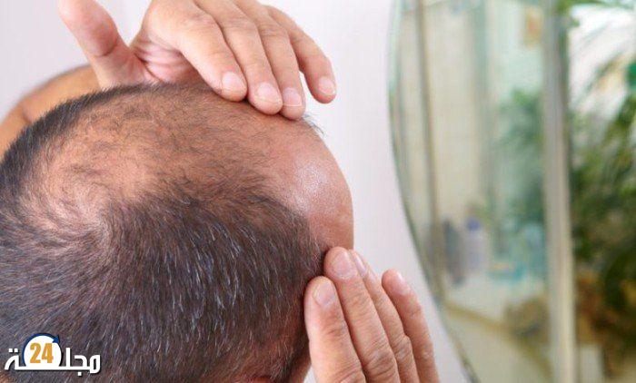 هل يسبب التوتر الصلع؟