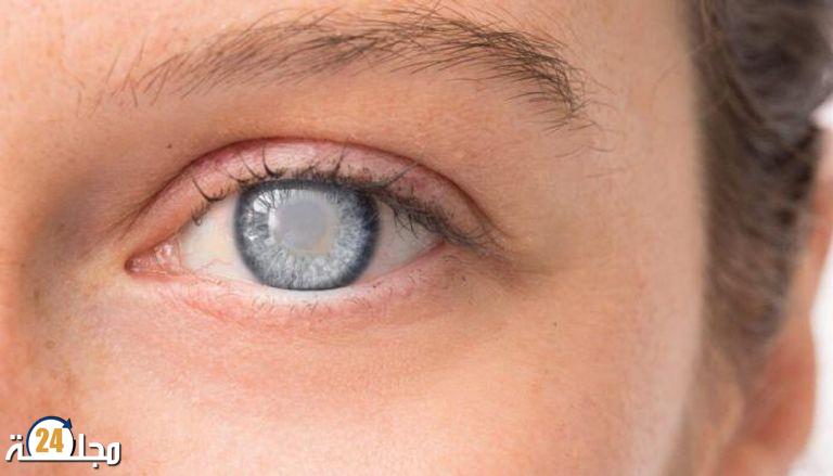 تحذير من “سارق البصر”..  أسئلة تساعدك في الكشف المبكر