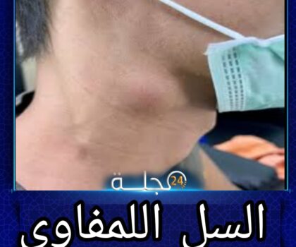 أزلو محمد يكتب: داء السل اللمفاوي: تحديات صحية ومعضلات تنموية في المغرب